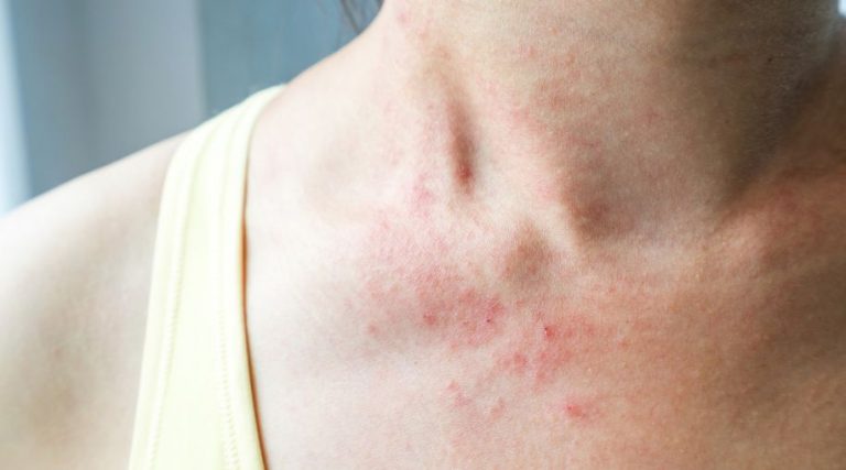 eczema treatment