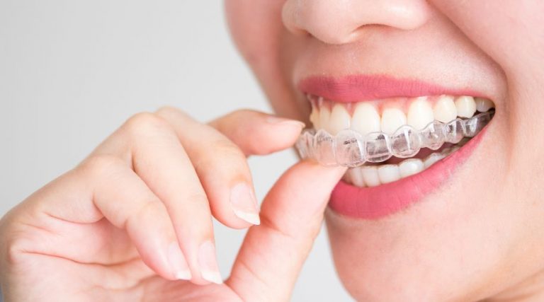 how to straighten teeth