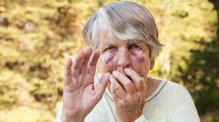 old age bruising